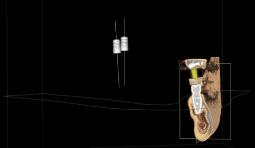 Figure 5: Actual guided implant 3D view post-op