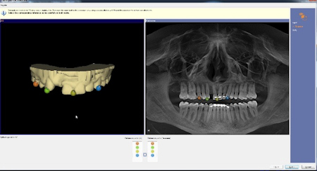 Integration of data between CAD/CAM and CBCT