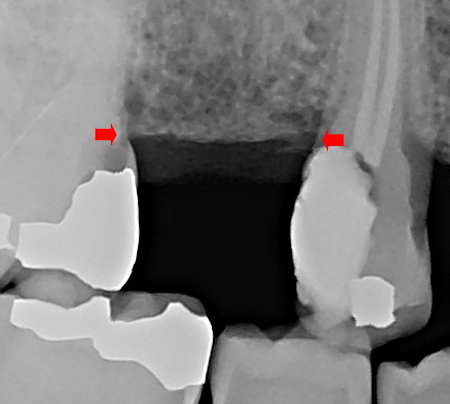 Bone level shown in preoperative radiograph