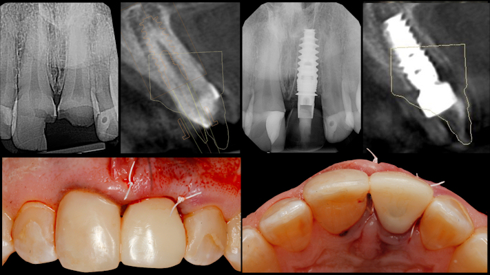 Care was taken to leave the restoration out of occlusion