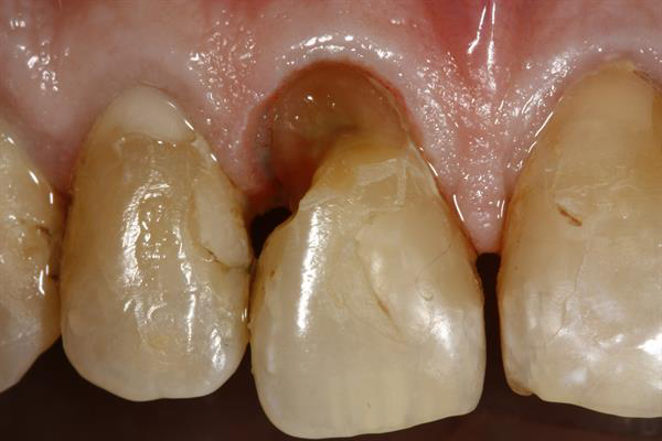 Tooth No. 8 after the gingivectomy but before final restoration
