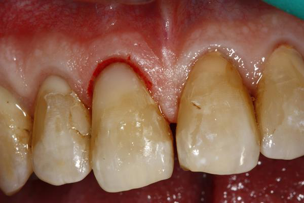 Restored tooth immediately after the procedure