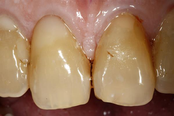  Restored tooth at follow-up six days after the procedure