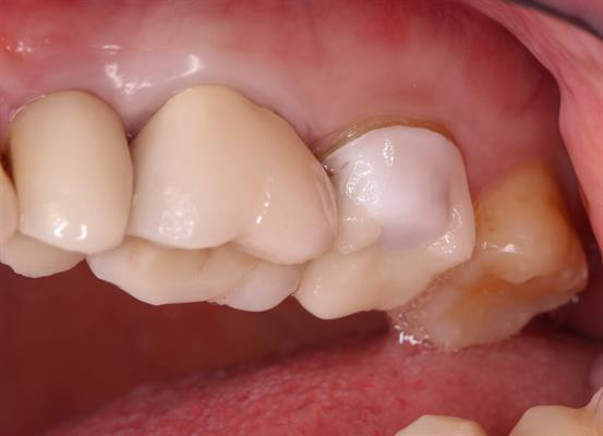 Preoperative image of tooth #15