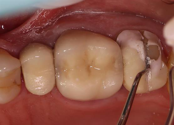 The exposed zirconia can be seen in this view of sectioned tooth #15