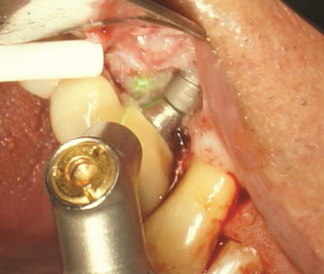 The removal of granulation tissue in bony defect is completed
