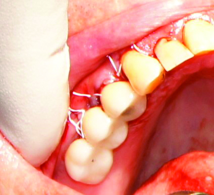 The full-thickness flap was heavily released for untensioned closure