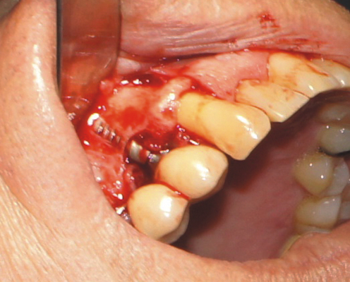 A full-thickness curvilinear approach was taken in this patient