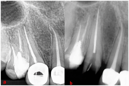 Diagnostic radiography before and after removal of the metal ceramic crown
