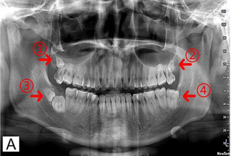 Pretreatment panoramic tomogram showed three supernumerary teeth in all four quadrants
