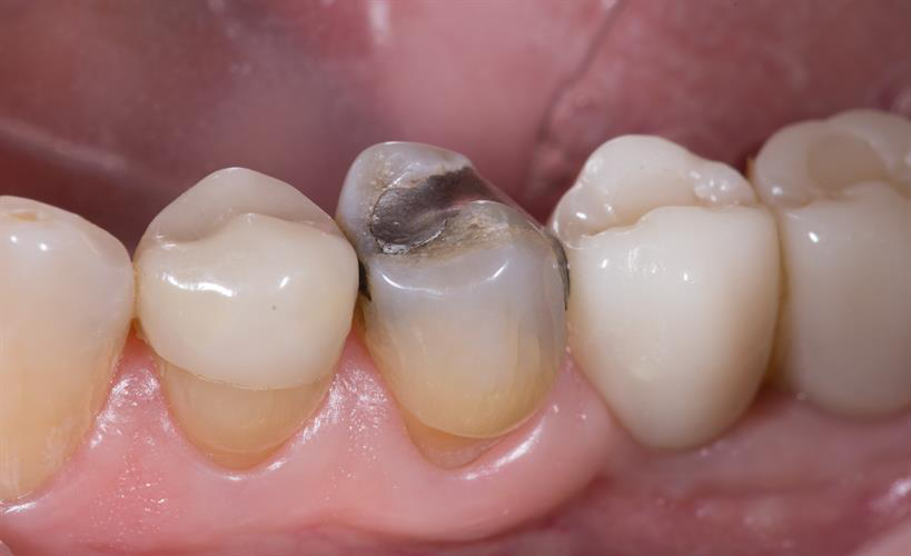Large, failing distal-occlusal-buccal amalgam restoration with mesial recurrent decay, mesial marginal ridge crack, and buccal cuspal attrition and wear facet