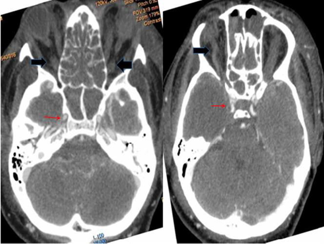 Axial computed tomography (CT) angiography shows normal enhancement of cavernous carotid artery (red arrows) with thrombosed and dilated superior ophthalmic veins (black arrows)