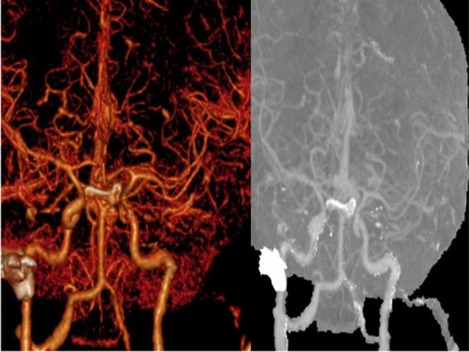 Reconstructive 3D image shows cavernous sinus thrombosis with patent carotid artery system