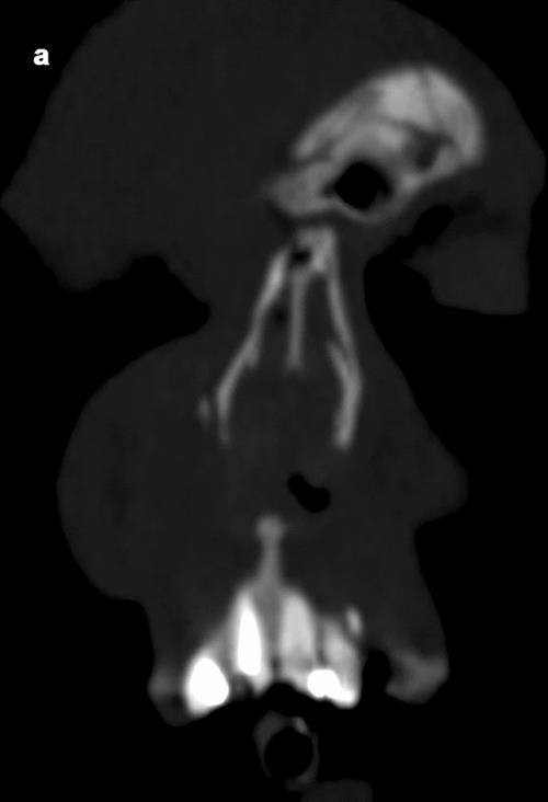 Maximum intensity projection CT scan in the coronal plane of a 21-year-old man with a root fracture of the left upper incisor