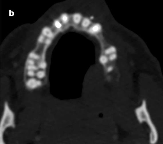 The tooth fragment is also visible in the axial plane