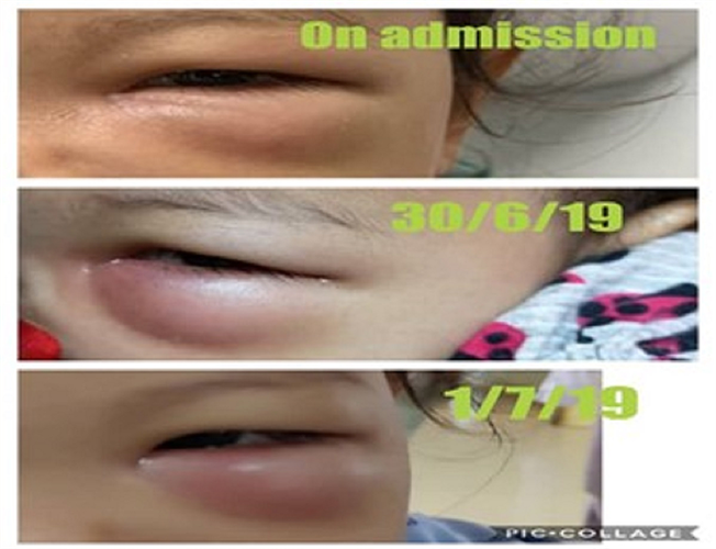 The progression of the swelling, which worsened on the third day after admission, of the girl