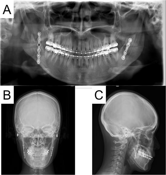 Postoperative radiographs of the patient showed no abnormalities
