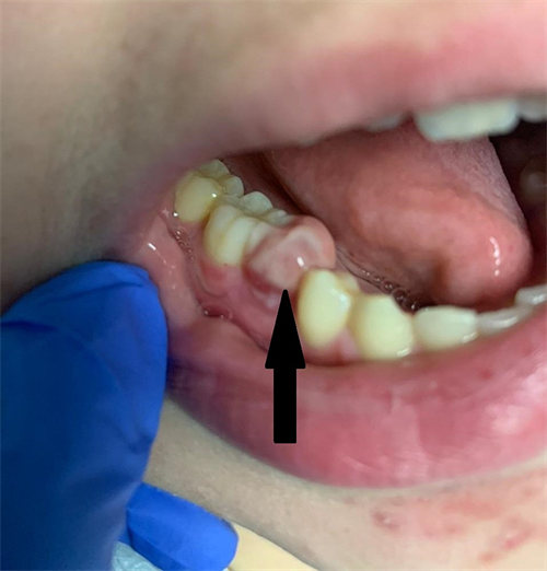 An oral exam showed gingival swelling