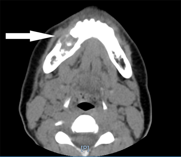 A CT scan without contrast shows a lytic lesion of the right mandible