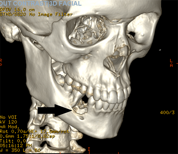 A 3D reconstruction of the scan shows the lytic lesion of the right mandible.