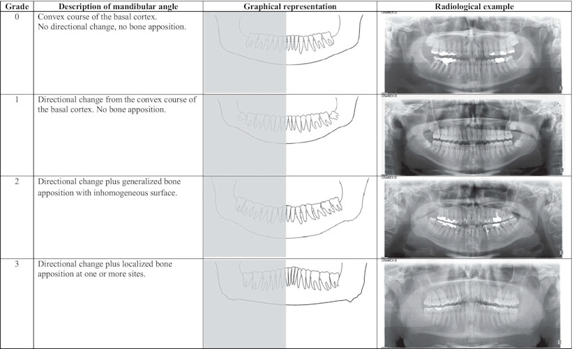 Radiological example of bone apposition at the mandibular angle.