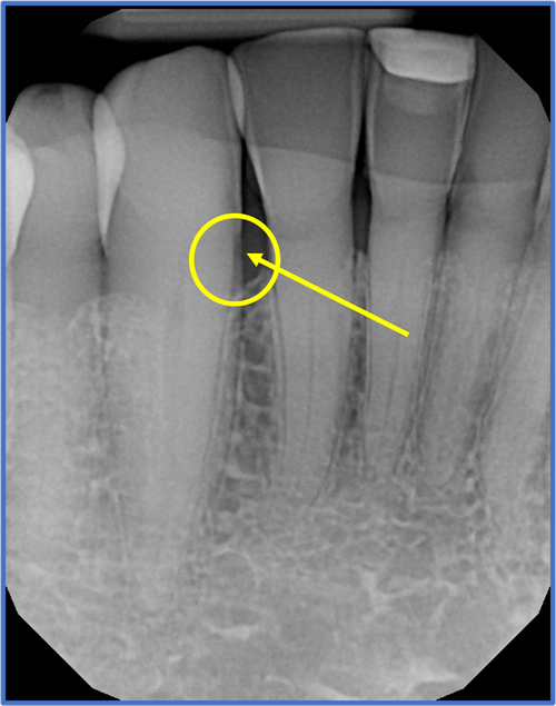A dental x-ray showing root decay on the mesial of #27