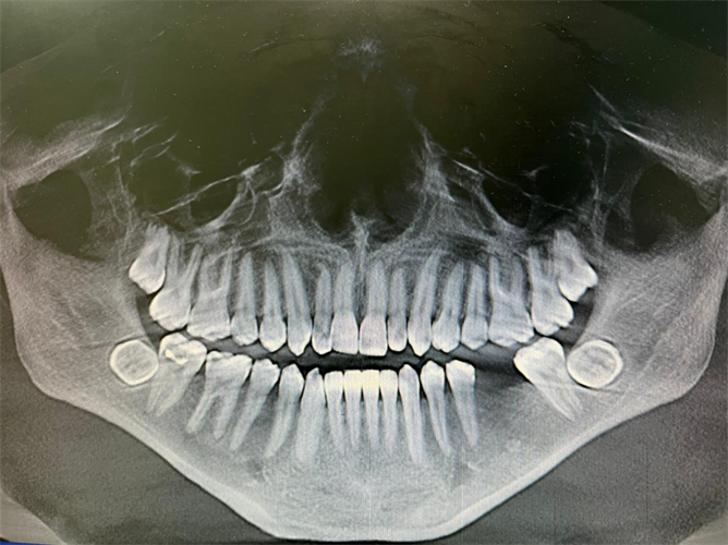 Panoramic screening radiograph shows bilateral impacted mandibular third molars