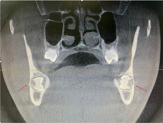 Sagittal CBCT shows the bilateral symmetrically impacted teeth
