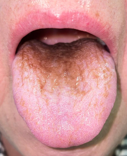 A 69-year-old woman developed a brown discoloration with carpetlike elongated filiform papillae after taking moxifloxacin