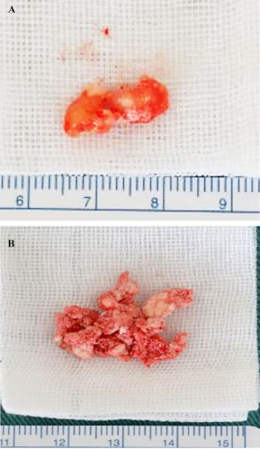 (A) An image of cartilagelike structures of mixed sizes within a hyperplastic fibrous tissue that was removed from the patient. (B) A bone and chalklike tissue specimen that was removed from the patient.