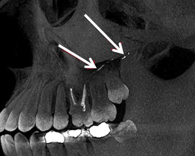 A CBCT image shows opaque material in the root of the posterior superior alveolar artery.