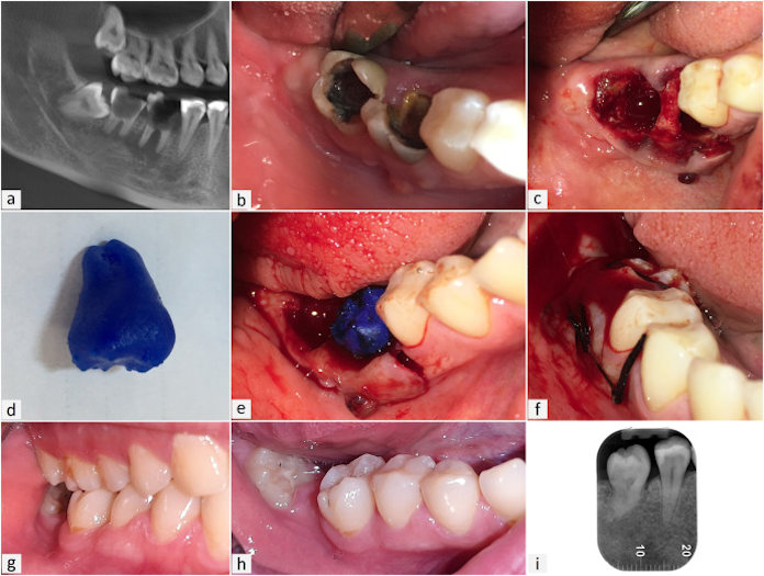 Tooth autotransplantation process.