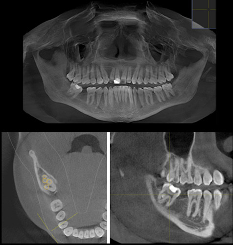 Multiple CBCT slices revealed the unilateral fused third with a continuous pulp chamber. The axial view revealed the tooth had five canals