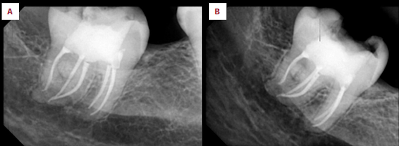 An intraoral x-ray shows (A) a postoperative x-ray of the man