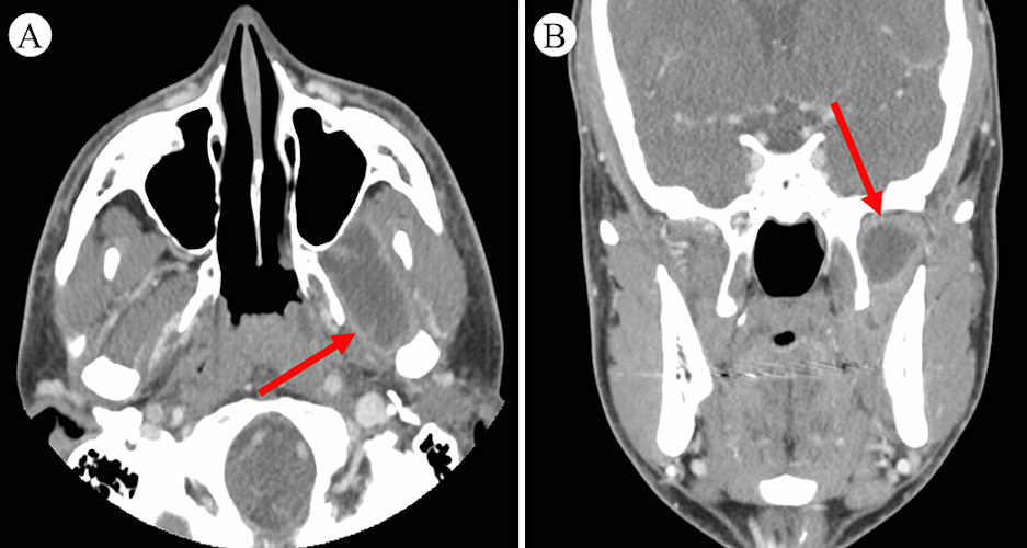 A maxillofacial CT scan reveals an infratemporal fossa abscess of the man