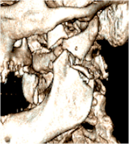 A 3D image showing a left mandibular ramus fracture