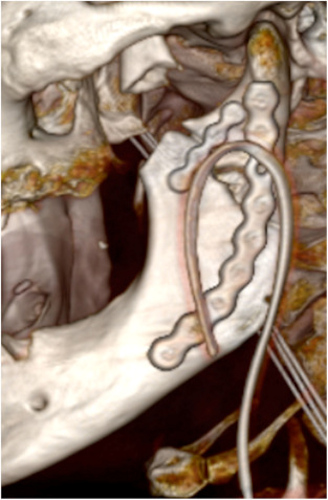 A 3D image showing a correct reduction of the left mandibular ramus fracture after surgery