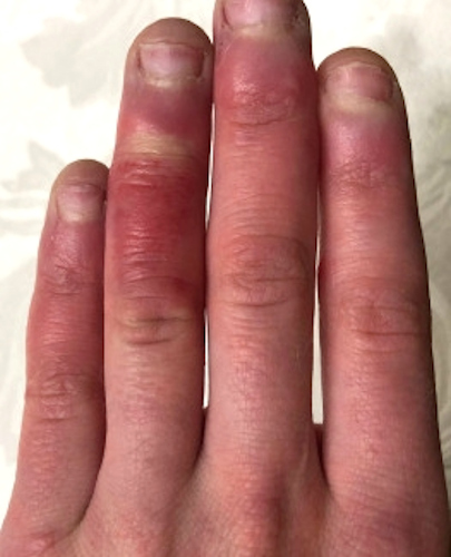 During SARS-CoV-2 infection, "COVID fingers" can occur, which is characterized by purplish discoloration and swelling