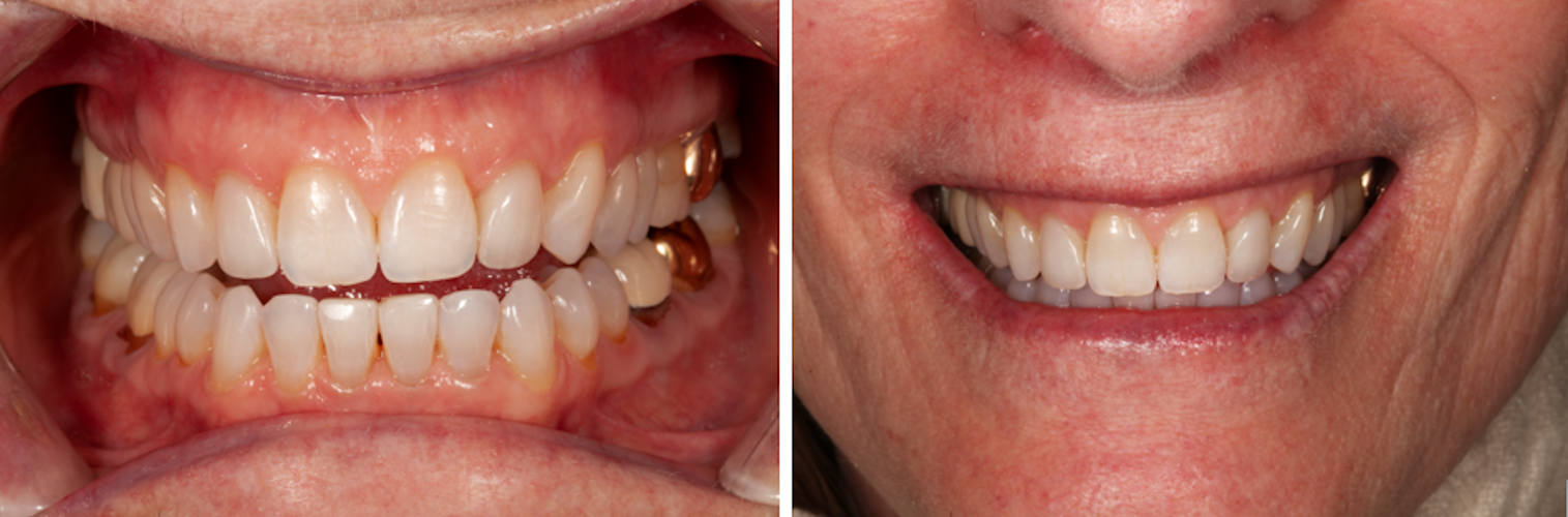 Postop retracted view after direct composite bonding and postop full smile view