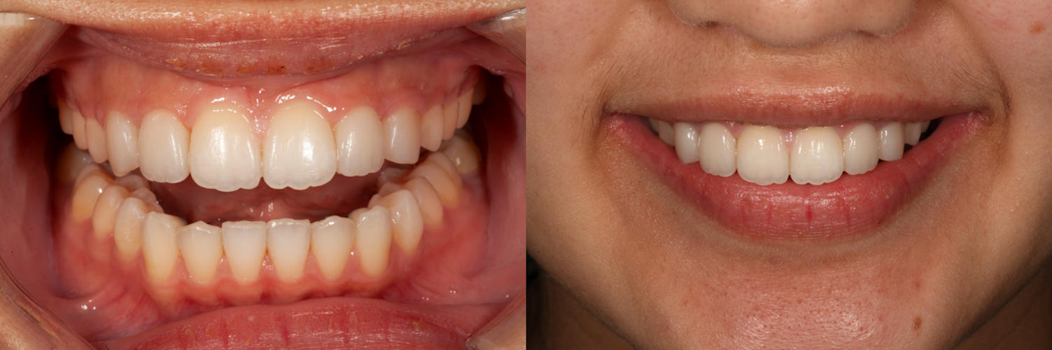 Postop retracted view after direct composite bonding and postop full smile view