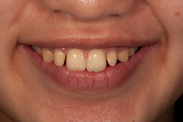 Preop full smile view before whitening