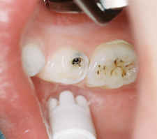 Two teeth treated with silver diamine fluoride
