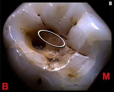 Stereo microscopical image of right third molar