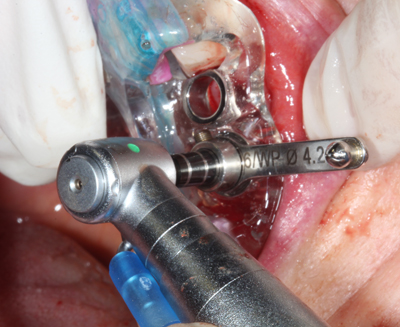 Figure 14: Final implant osteotomy