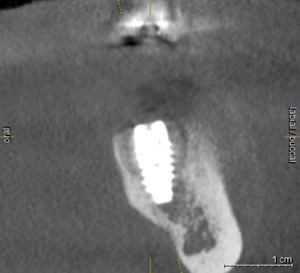 Figure 2: A well-positioned guided implant
