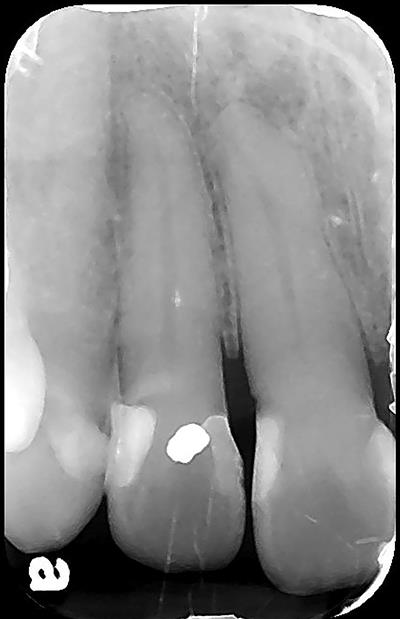 Preoperative radiograph of the tooth