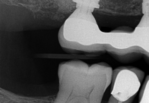 Preoperative radiograph of the implant on tooth #5