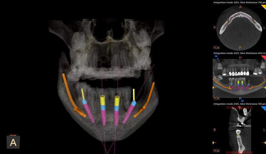 3D view showing all implants treatment planned