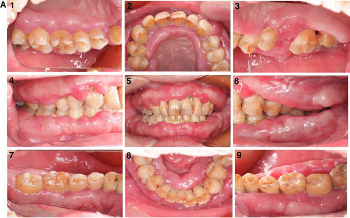 Clinical images showing gum swelling and poor oral hygiene