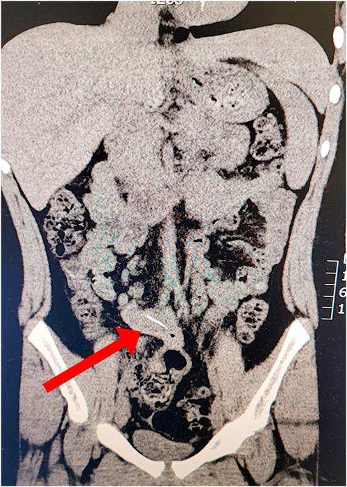 Computed tomography (CT) scan shows a 2.7-cm linear object in the girl